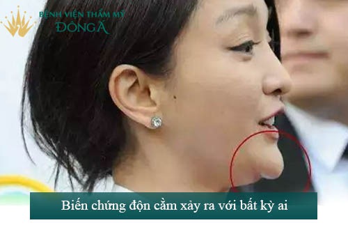 Độn cằm có nguy hiểm không & Lưu ý Quan Trọng cần biết 3
