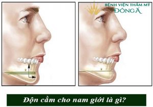 Độn cằm cho nam giới – An Toàn – Cằm thon gọn chuẩn soái ca sau 40′
