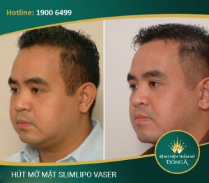 7 Cách giảm mỡ mặt Nam hiệu quả: Mặt thon gọn, Góc cạnh
