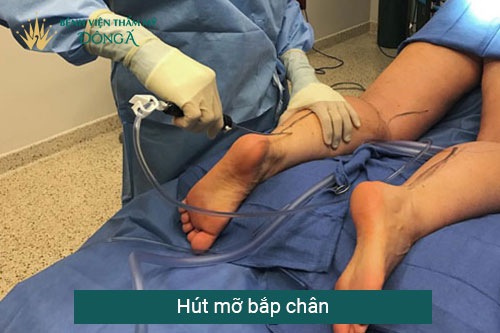 Hút mỡ bắp chân giá bao nhiêu tiền? 4 Cách tiết kiệm chi phí 3