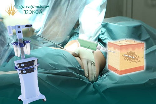 Hút mỡ bắp chân giá bao nhiêu tiền? 4 Cách tiết kiệm chi phí 4
