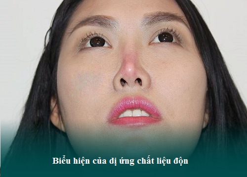 Nâng mũi sụn nhân tạo được bao lâu? Có được vĩnh viễn không? Hình 3