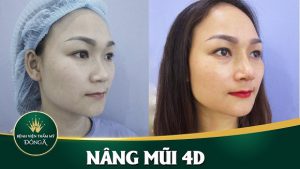 Nâng mũi sụn sườn có vĩnh viễn không? Giá bao nhiêu là hợp lý?