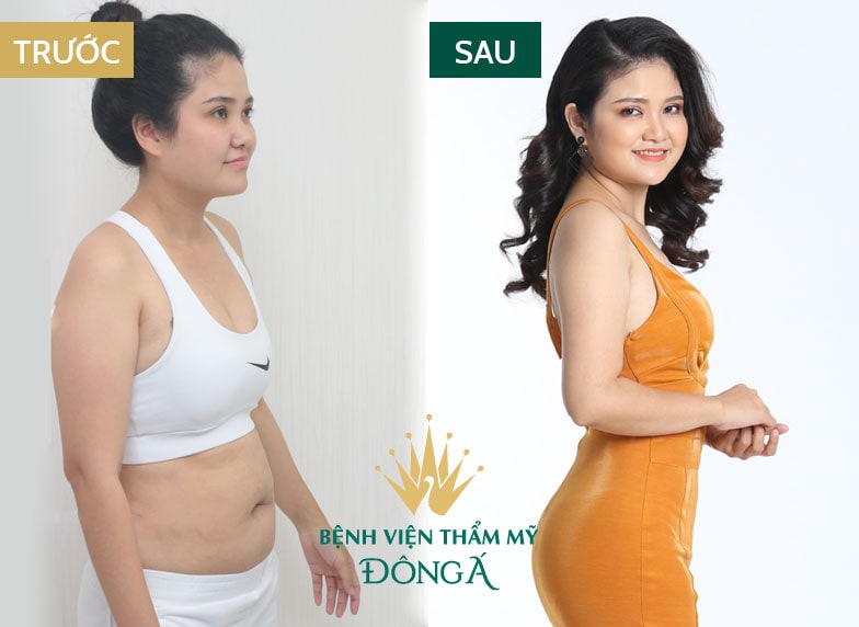 Phẫu thuật căng da bụng nội soi giá bao nhiêu? Cơ sở nào uy tín? Hình 4