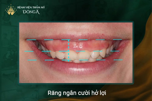 Phụ nữ cười hở lợi là người thì sao, tốt hay xấu, có ý nghĩa gì? 2