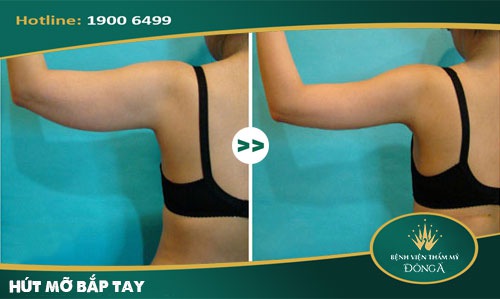 Giảm mỡ bắp tay bằng muối: 5 Tuyệt chiêu hiệu quả cấp tốc 8