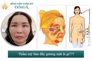 Thẩm mỹ làm đầy khuôn mặt là gì? Giá bao nhiêu tiền?
