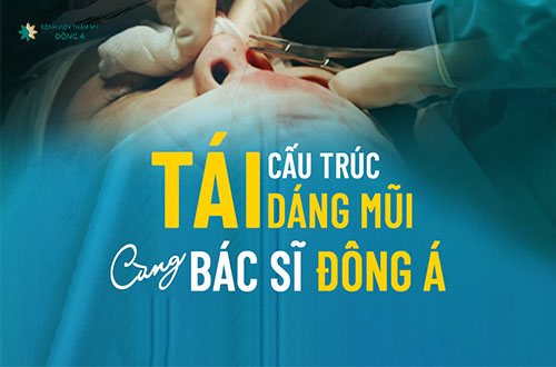 kỹ thuật nâng mũi Sline