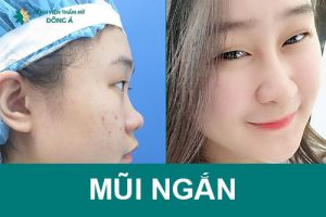 Tướng mũi ngắn nói lên điều gì? Cách sửa mũi ngắn, cải biến vận mệnh