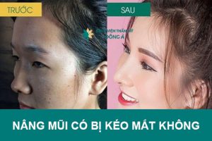 Nâng mũi có bị kéo mắt không? Cùng BVTM Đông Á truy tìm “Sự Thật”