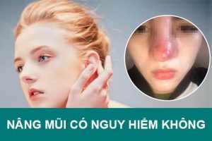 Nâng mũi có Nguy Hiểm không? Ảnh hưởng gì đến sức khỏe về sau?