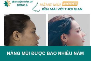 Nâng mũi được bao nhiêu năm? Kéo dài được bao lâu?