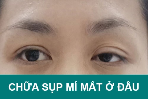 “Truy lùng” địa chỉ chữa sụp mí mắt ở đâu tốt & an toàn nhất hiện nay?