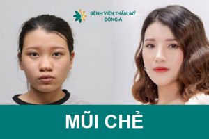 Từ A-Z về tướng mũi chẻ và cách sửa mũi chẻ phù hợp nhất!