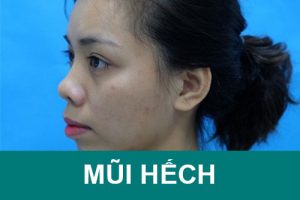 Mũi hếch là gì? Tướng số/thẩm mỹ đẹp hay xấu? Cách chỉnh sửa