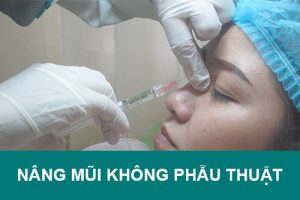 Nâng mũi không phẫu thuật là gì? Giá bao nhiêu? Được bao lâu