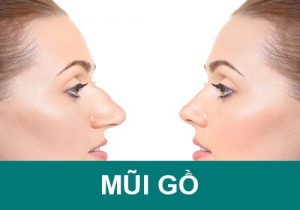 Mũi Gồ Ghề: Xem tướng số Nam, Nữ và cách sửa mũi đổi vận !!!