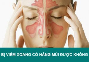 Tháo gỡ từ A-Z mọi khúc mắc: Bị viêm xoang có nâng mũi được không?