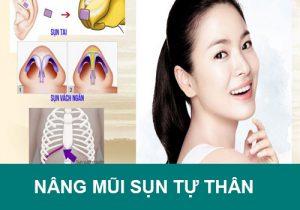 Nâng mũi sụn tự thân có vĩnh viễn không? Giá bao nhiêu tiền?