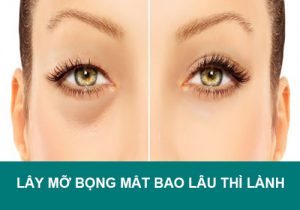 Lấy mỡ bọng mắt bao lâu thì lành? Lưu ý để mí nhanh đẹp