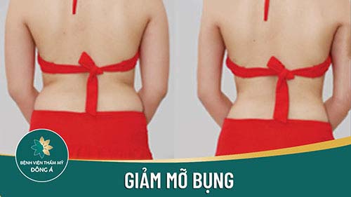 Giảm béo không phẫu thuật bằng công nghệ SlimLipo

