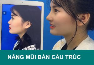 Nâng mũi bán cấu trúc là gì? Có vĩnh viễn không? Giá bao nhiêu?