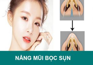 Nâng mũi bọc sụn có phải là lựa chọn tốt nhất? Lưu ý quan trọng nhất