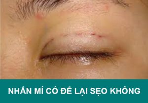 Nhấn mí có để lại SẸO không? Cách phòng tránh, khắc phục?