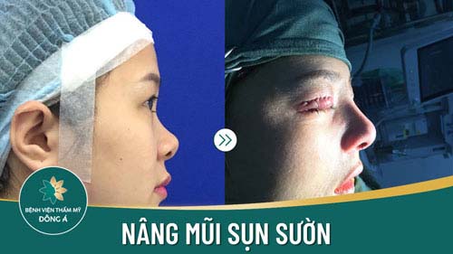 Nâng mũi sụn sườn 
