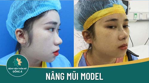 Nâng mũi Model Bán Cấu trúc
