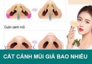 Cắt cánh mũi giá bao nhiêu? Có đắt không? Xem bảng chi phí mới nhất