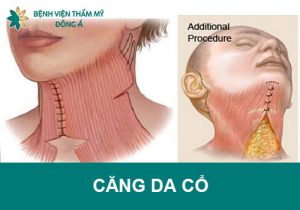 Căng da cổ: Phẫu thuật ở đâu an toàn, uy tín? Giá bao nhiêu tiền