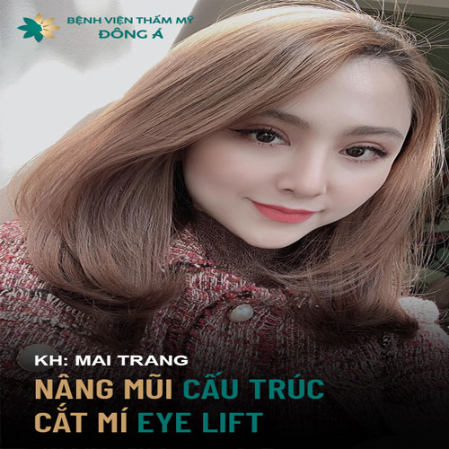 cắt mí mắt sưng bao lâu