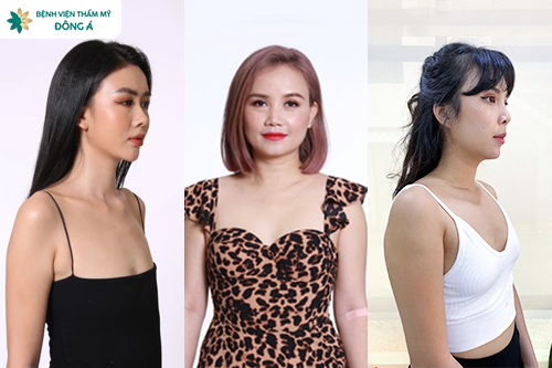 Nâng ngực Y-shape phù hợp với ai