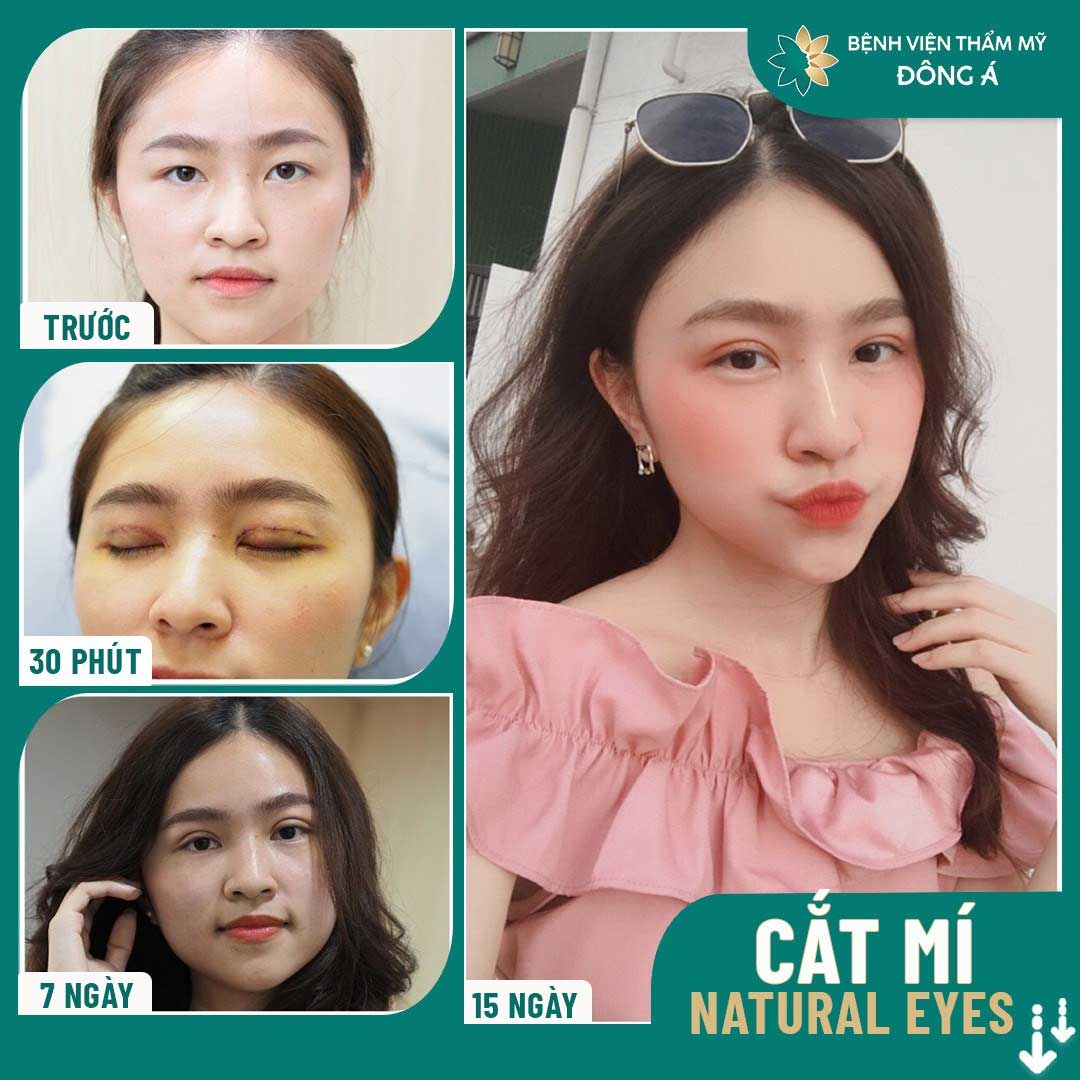 cắt mí có đau không