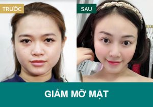 10 Cách giảm mỡ mặt nhanh, tự nhiên, hết béo chỉ sau 1 tuần