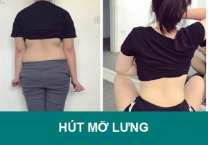 Hút mỡ lưng: Công nghệ hiện đại để làm đẹp? Giá bao nhiêu?