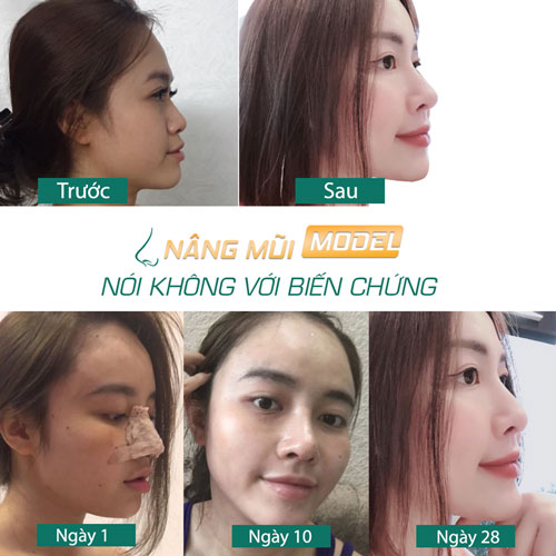 lấy sụn sườn nâng mũi