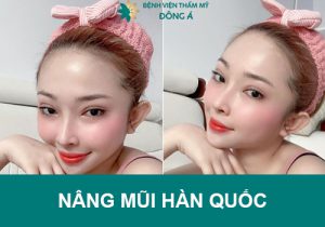 Nâng mũi Hàn Quốc xu hướng giá bao nhiêu tiền?