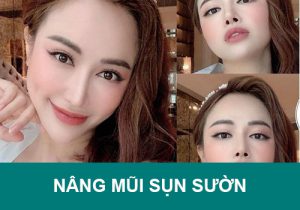 Nâng mũi sụn sườn Giá bao nhiêu? Có vĩnh viễn không?