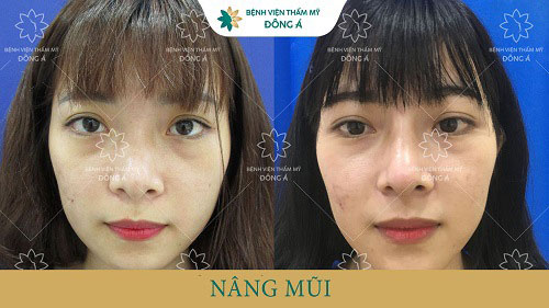 nâng mũi sụn sườn tự thân