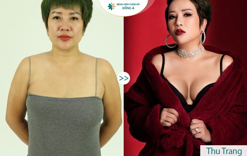 cải thiện vòng 1