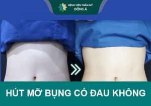 Hút mỡ bụng có đau không? 5 Mẹo giảm đau Nhanh chóng