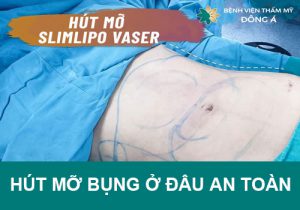 Hút mỡ bụng Ở Đâu AN TOÀN – Khách hàng gọi tên BV Thẩm mỹ ĐÔNG Á
