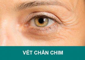 Bật mí bí quyết đánh bay vết chân chim “trong một nốt nhạc”