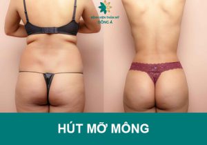Hút mỡ mông – giải pháp cho vòng 3 sexy, chuẩn dáng chỉ sau 1 nốt nhạc