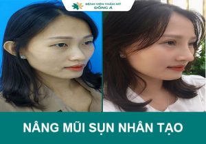 Nâng mũi sụn nhân tạo có an toàn không? Giá bao nhiêu?