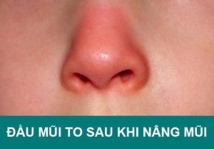 Cách “chữa cháy” đầu mũi to sau khi nâng mũi an toàn bạn nên biết