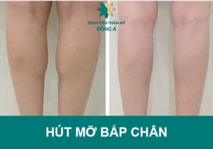 Hút mỡ bắp chân: Sở hữu đôi chân nhỏ nhắn, thon gọn chỉ sau 1h đồng hồ