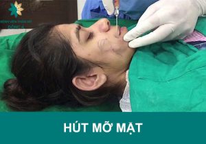 Công nghệ hút mỡ mặt Vaser Lipo: An toàn – Hiệu quả nhanh – Giá rẻ